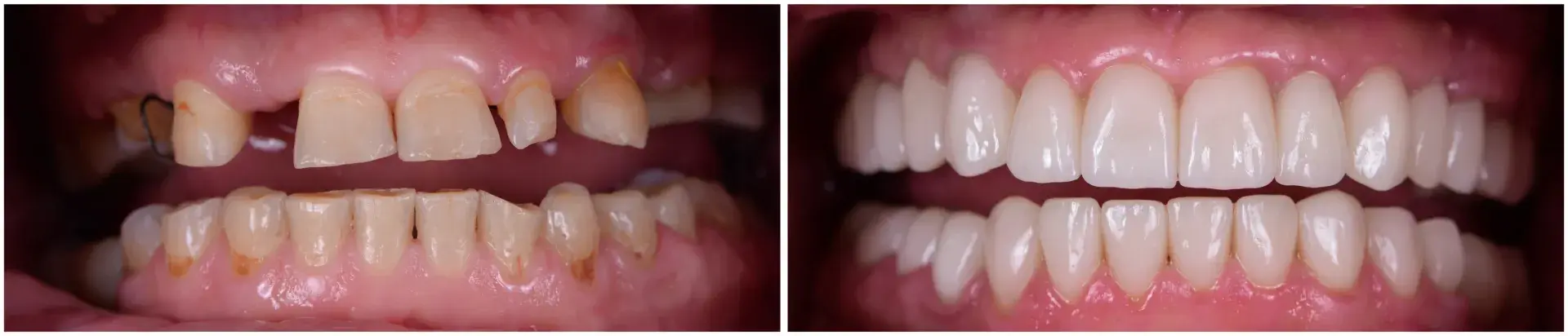 Before and after smile makeover results