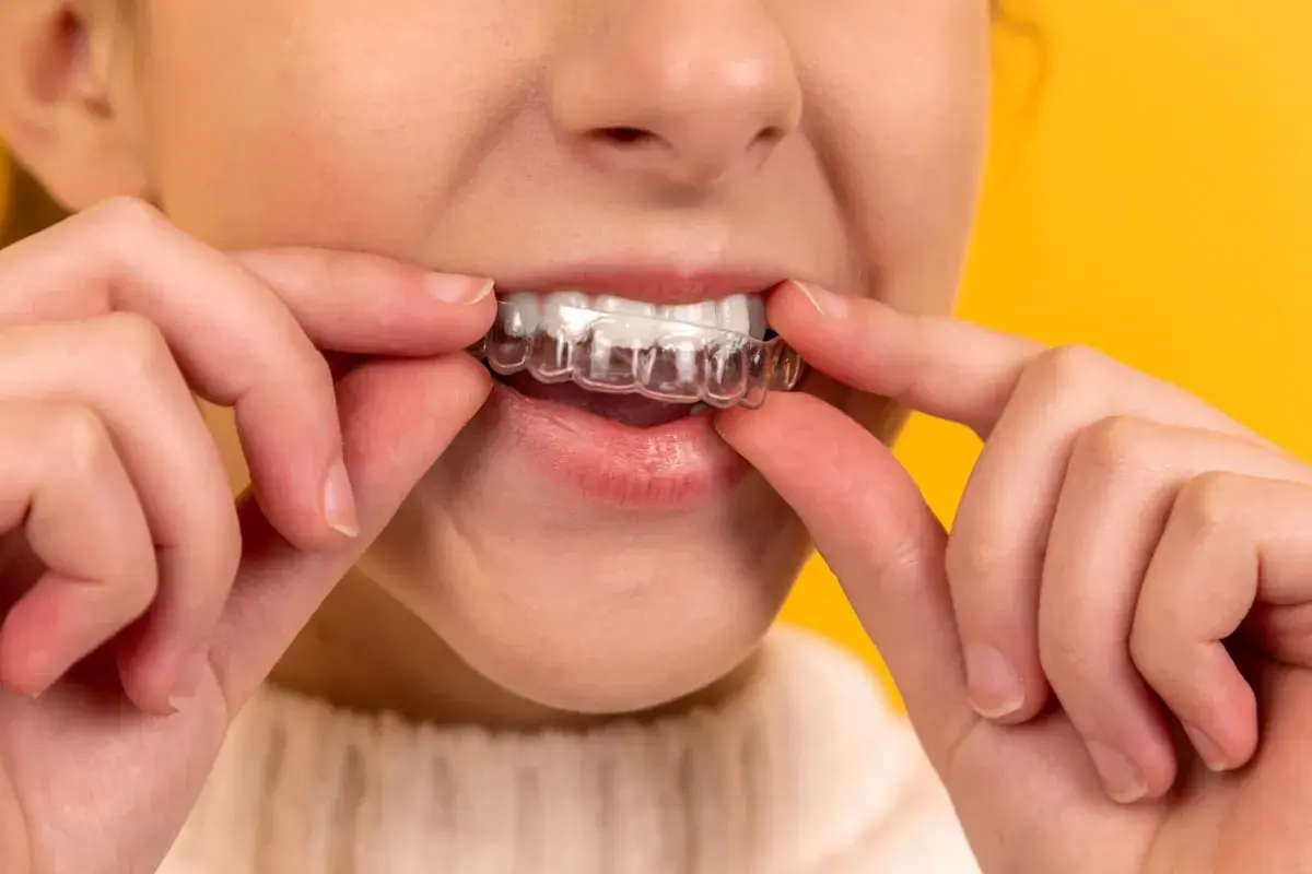 Invisalign clear aligner